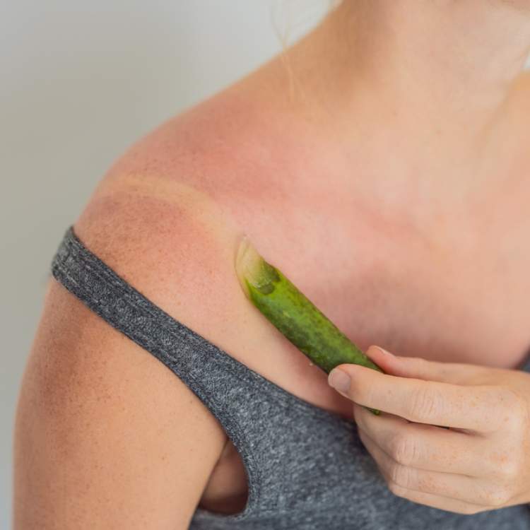 coup de soleil et aloe vera