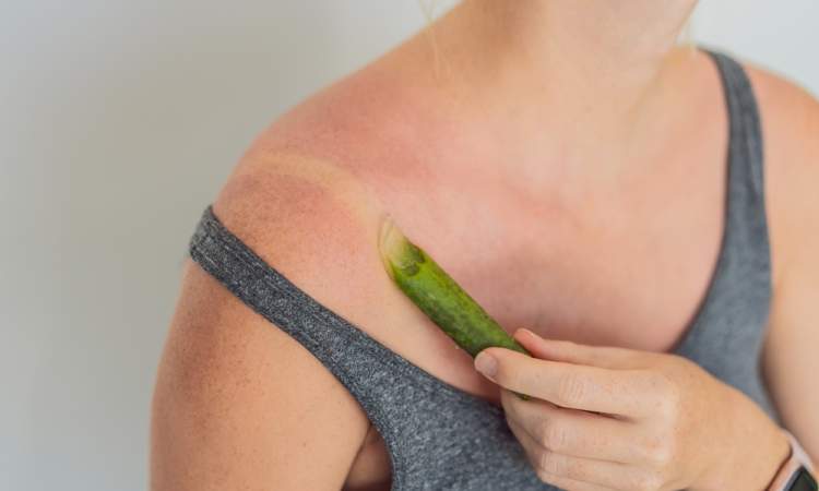 coup de soleil et aloe vera