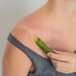 coup de soleil et aloe vera