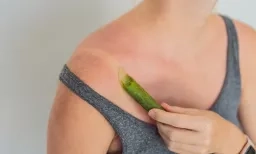 coup de soleil et aloe vera