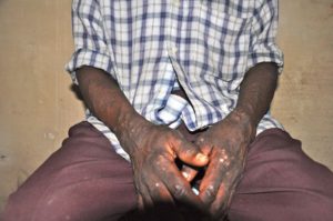 les bras marqués par les substtances chimiques